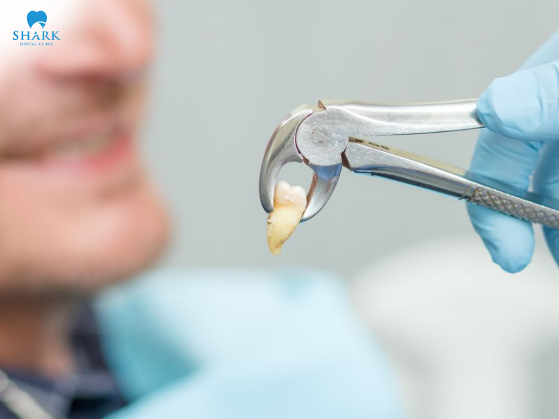 Răng khôn mọc lệch, viêm đau tái phát hoặc gây hại răng bên cạnh thường được chỉ định nhổ sớm để tránh biến chứng