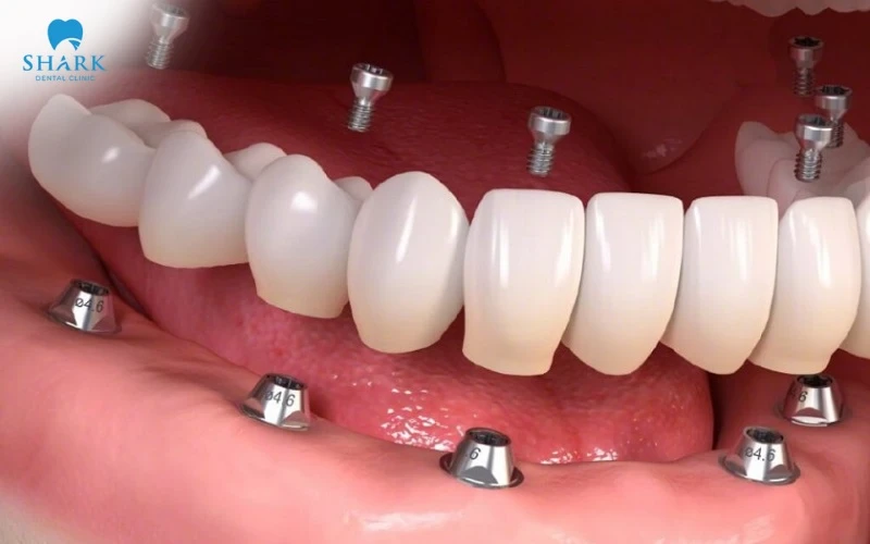 Cylinder Implant là gì? Cấu tạo và ưu nhược điểm của trụ 9 Cylinder Implant có tính tương thích sinh học cao