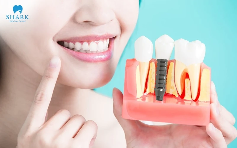 Trụ Implant cắm trực tiếp vào xương hàm với lực ăn nhai liên tục sẽ tránh được hiện tại tiêu xương