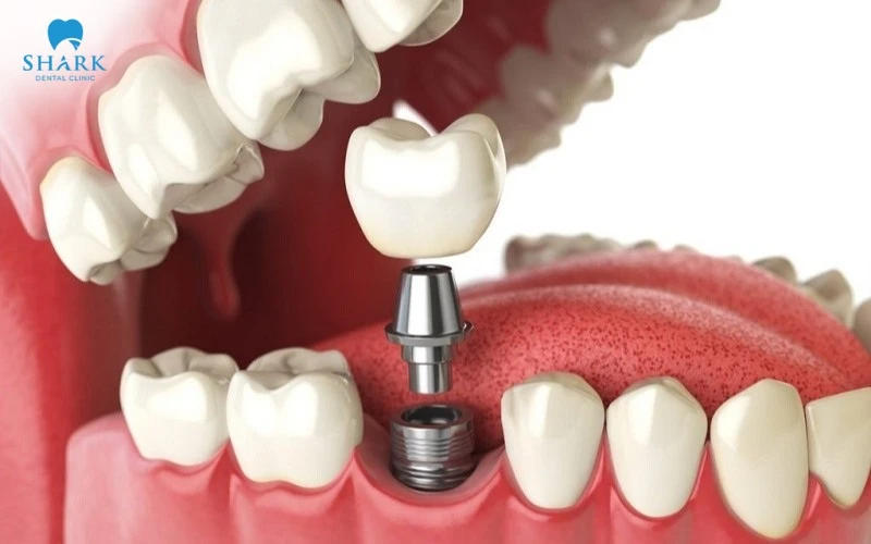 Cylinder Implant là gì? Cấu tạo và ưu nhược điểm của trụ 10 Trồng răng Cylinder có 3 loại phổ biến