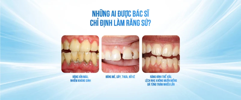 Đối tượng nên làm răng sứ