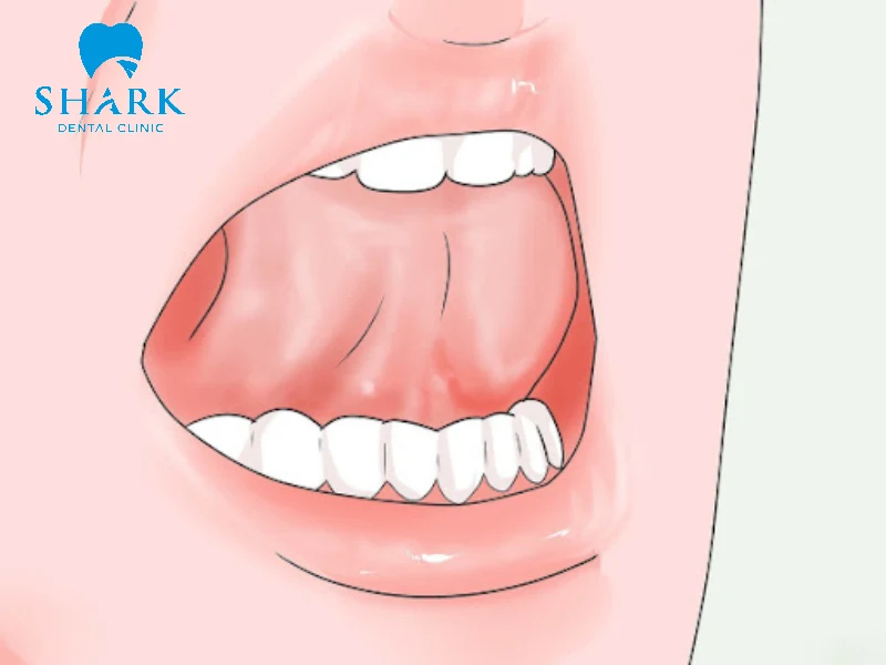 Dùng lưỡi đẩy răng