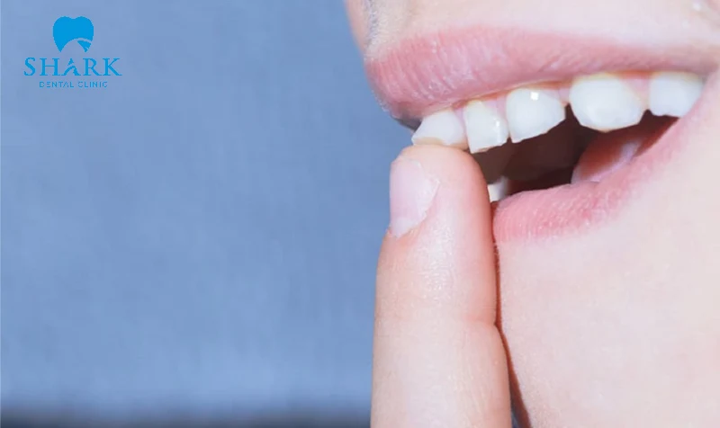 Dùng tay để đẩy răng