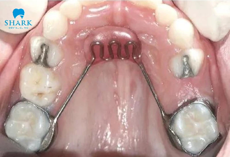 Hàm giữ khoảng 2 bên