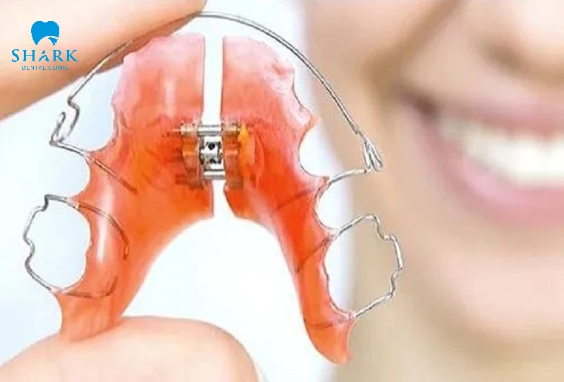 Hàm giữ khoảng dạng tháo lắp