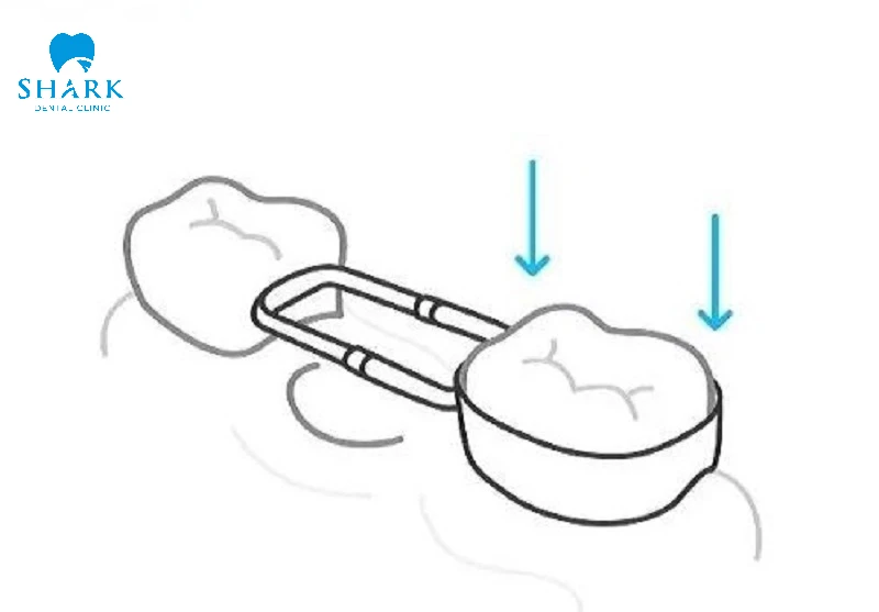 Hàm giữ khoảng 1 bên