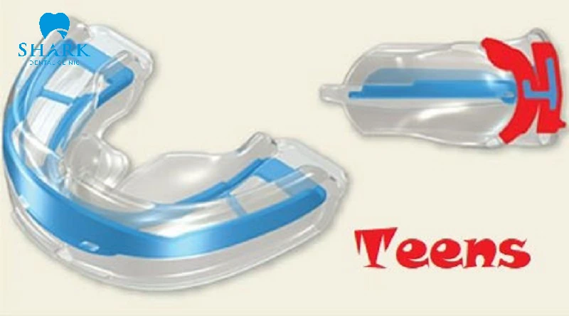 Hàm tiền chỉnh nha: Giải pháp vàng giúp nắn chỉnh răng cho bé 13 Hình ảnh hàm Trainer dòng Teens