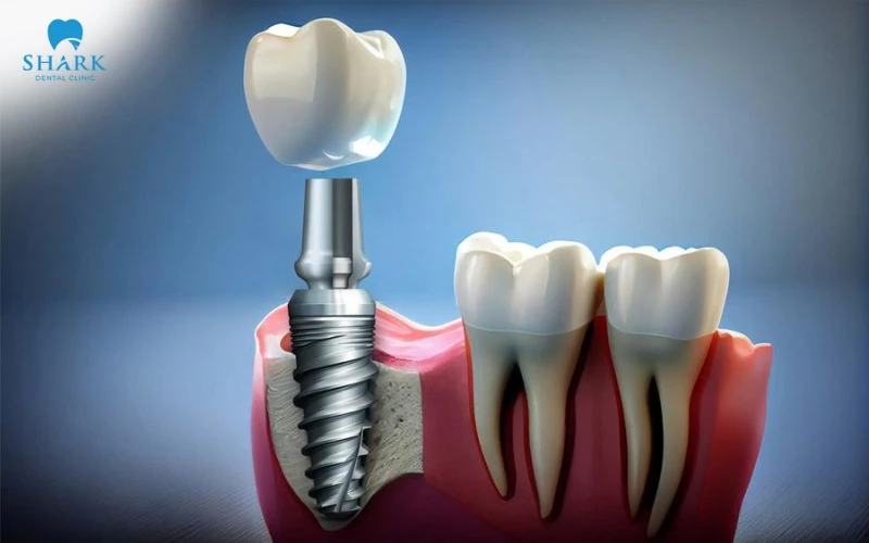 Trụ Hahn tích hợp xương nhanh