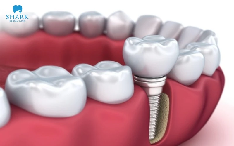 Cấy ghép Implant Hahn có mức cho phí thuộc loại cao cấp