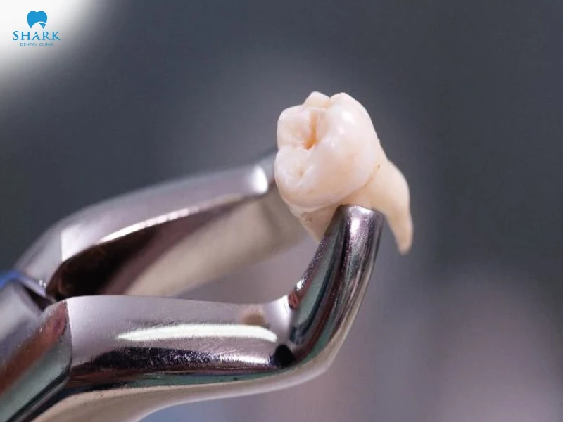 Không nhổ răng khôn có sao không? khi nào nên nhổ bỏ? 7 Răng khôn là chiếc răng mọc ở vị trị cuối cùng trong hàm, thường xuất hiện vào độ tuổi 17 - 25.