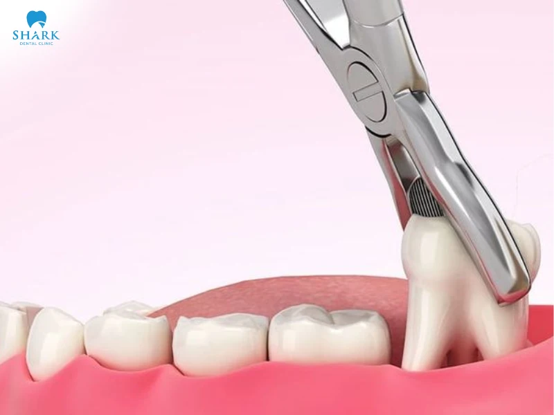 Không nhổ răng khôn có sao không? khi nào nên nhổ bỏ? 8 Trong các trường hợp biến chứng răng khôn như răng khôn mọc lệch, mọc ngầm, sâu răng khôn,.. nên được cân nhắc nhổ bỏ sớm để tránh biến chứng về sau