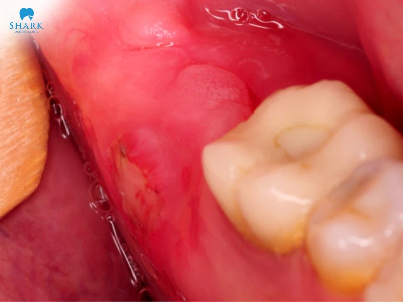 Không nhổ răng khôn có sao không? khi nào nên nhổ bỏ? 10 Trong một số trường hợp không chăm sóc răng miệng đúng cách sau khi nhổ răng khôn có thể gây ra biến chứng nhiễm trùng răng khôn