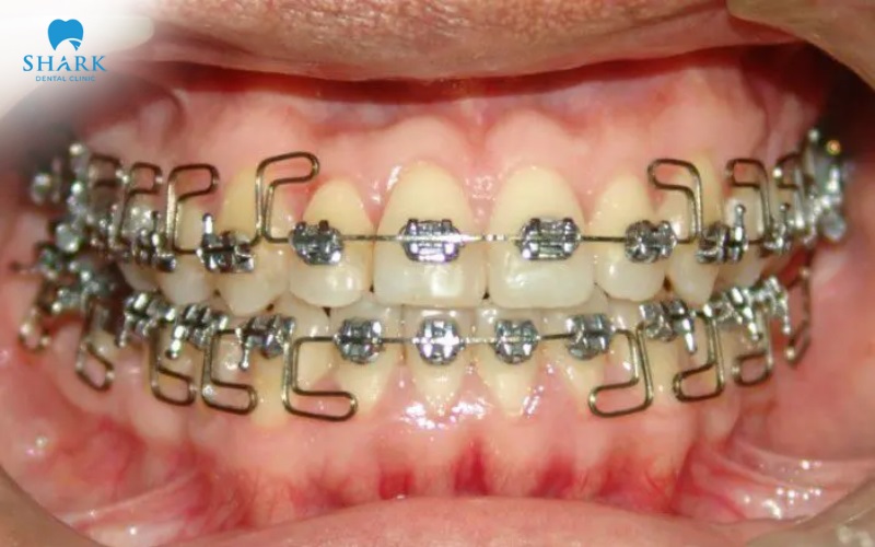 Kỹ thuật Meaw trong niềng răng