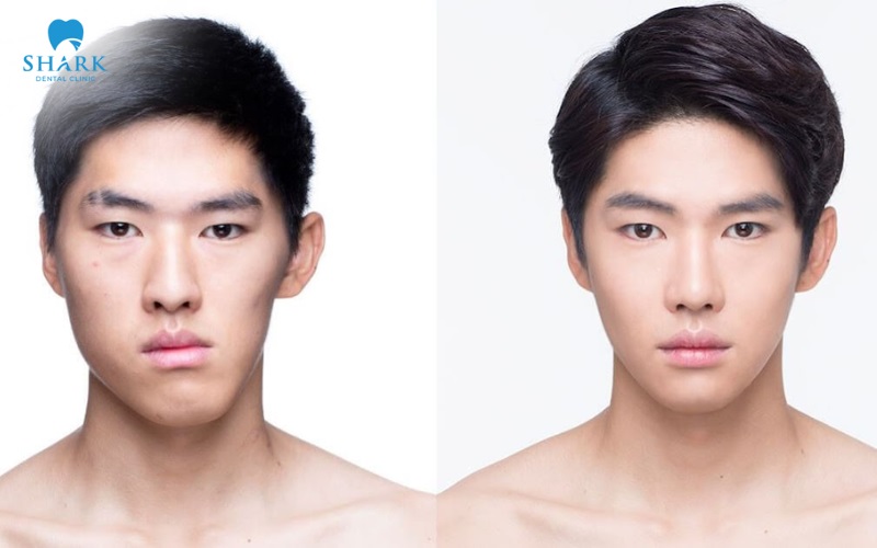 Người lệch mặt nặng có thể được chỉ định sử dụng kỹ thuật Meaw khi niềng