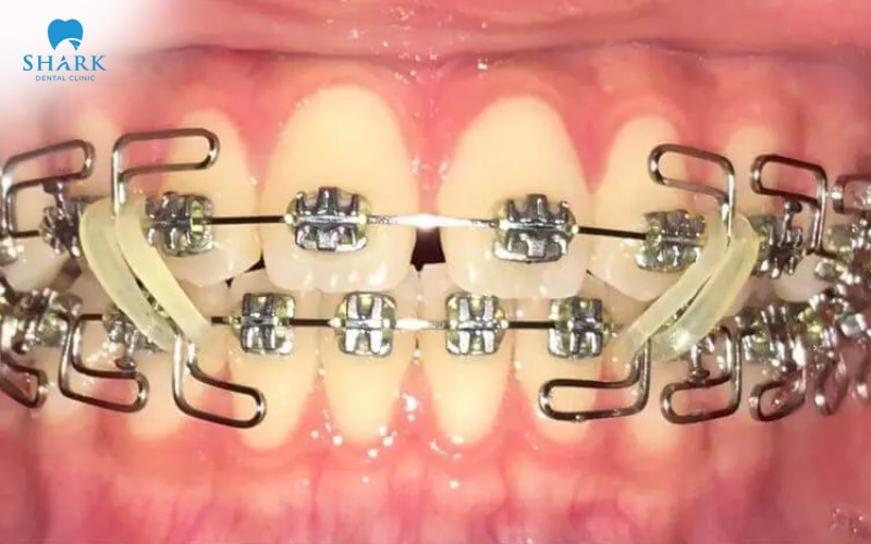 Kết quả Meaw trong chỉnh nha sẽ được giữ ổn định lâu dài