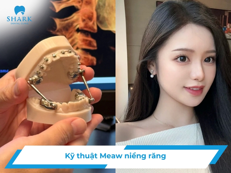 Kỹ thuật Meaw niềng răng