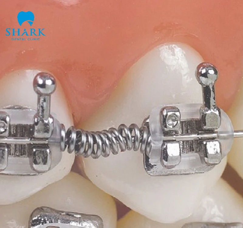 Hình ảnh minh họa lò xo đẩy có tác dụng đẩy 2 răng ra tạo khoảng trống