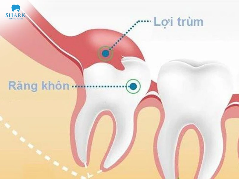 Lợi trùm răng khôn có tự hết không? Cách khắc phục hiệu quả 11 Lợi trùm răng khôn là tình trạng phần nướu phủ lên thân răng khôn đang mọc, dễ gây giắt thức ăn, viêm sưng và đau nhức