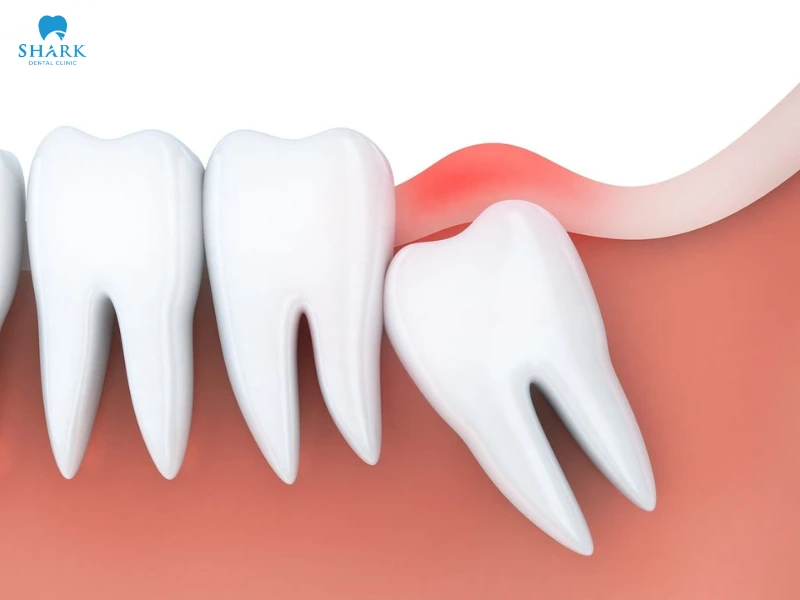 Lợi trùm răng khôn có tự hết không? Cách khắc phục hiệu quả 12 Lợi trùm răng khôn thường không tự hết nếu răng mọc lệch hoặc thiếu chỗ, và có thể tái viêm nhiều lần nếu không được xử lý đúng cách