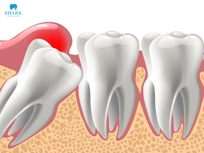 Lợi trùm răng khôn có tự hết không? Cách khắc phục hiệu quả 13 Lợi trùm răng khôn thường xuất hiện khi răng mọc lệch hoặc mọc ngầm, khiến nướu không thể mở hết và dễ bị viêm tái phát