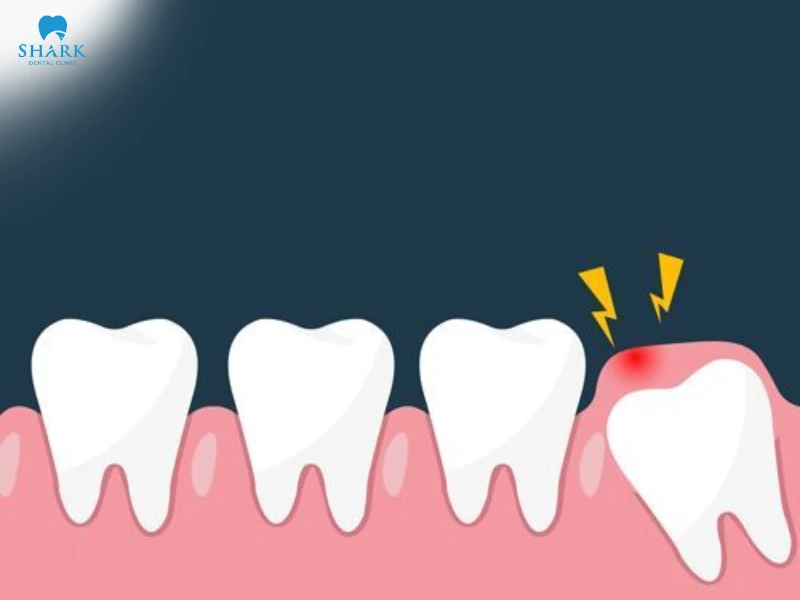 Lợi trùm răng khôn có tự hết không? Cách khắc phục hiệu quả 14 Lợi sưng tấy, đỏ và đau ở vùng trong cùng hàm là dấu hiệu điển hình của lợi trùm răng khôn đang viêm