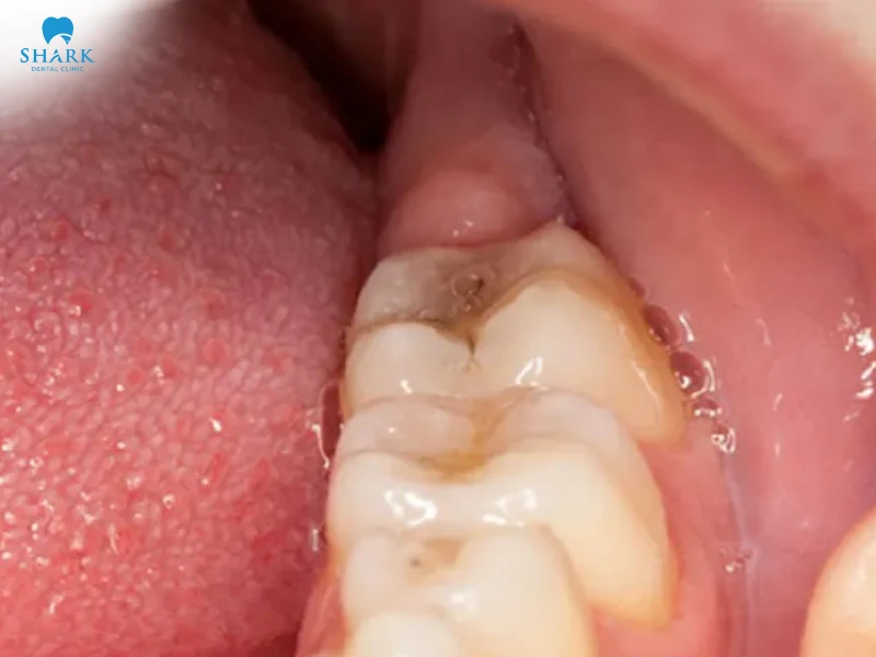 Lợi trùm răng khôn có tự hết không? Cách khắc phục hiệu quả 15 Lợi trùm răng khôn kéo dài có thể dẫn đến nhiễm trùng nướu, gây đau nhức, chảy mủ và hôi miệng