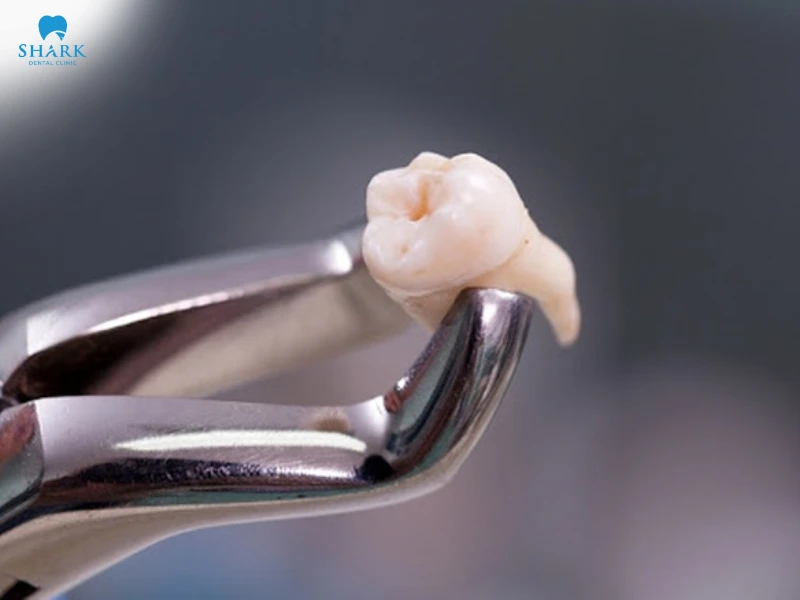 Lợi trùm răng khôn có tự hết không? Cách khắc phục hiệu quả 18 Nhổ răng khôn là giải pháp loại bỏ nguyên nhân gây viêm tái phát và ngăn tình trạng sưng đau kéo dài