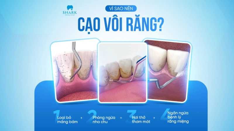Cạo vôi răng là gì? Lợi ích của việc lấy cao răng định kỳ 13 Lý do nên cạo vôi răng