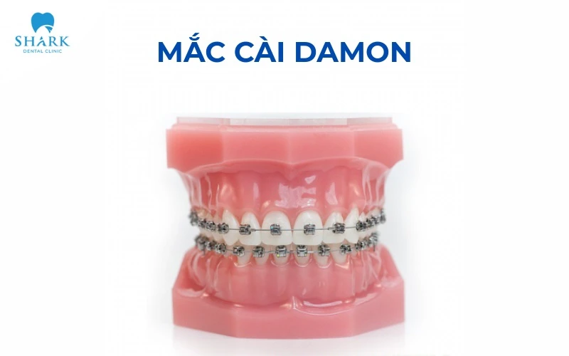 Niềng răng mắc cài Damon