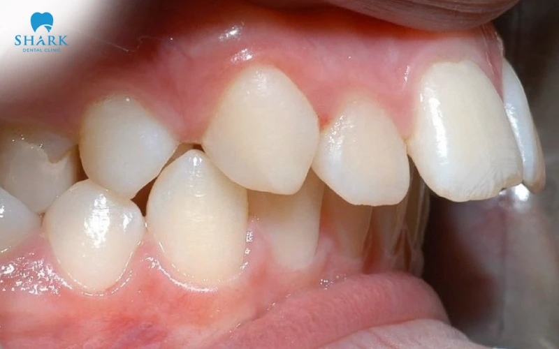 Người bị hô là đối tượng thích hợp để niềng răng Damon