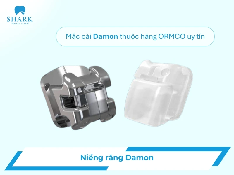 Niềng răng Damon