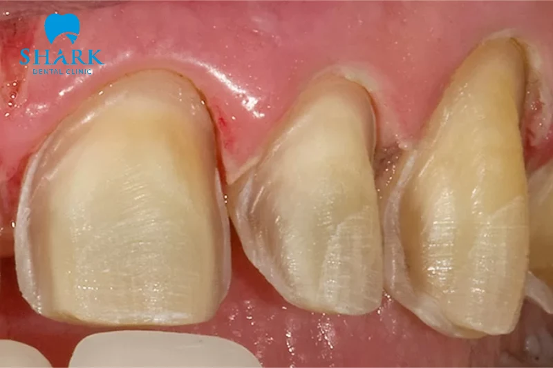 Mài răng để tinh chỉnh