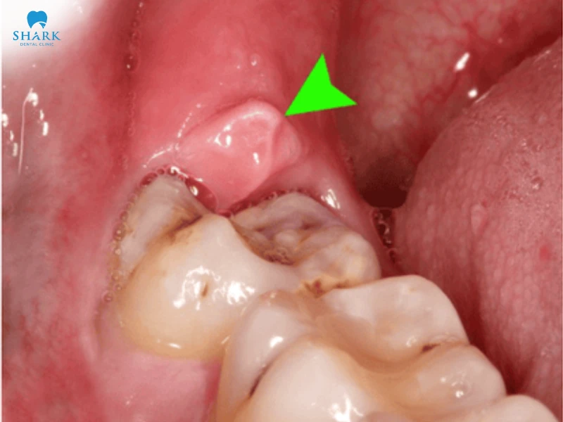 Mọc răng khôn hàm dưới có nguy hiểm không? Dấu hiệu bạn không nên bỏ qua 15 Mọc răng khôn hàm dưới có thể gây viêm lợi trùm do răng thiếu chỗ mọc, tạo điều kiện cho vi khuẩn tích tụ và gây sưng đau