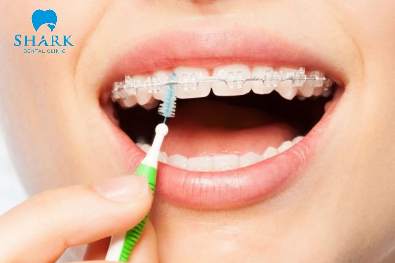Niềng răng có ăn được thịt gà không? Cần kiêng món gì? 11 Sử dụng bàn chải kẽ để làm sạch kẽ răng