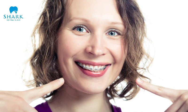 Người 50 tuổi có niềng răng được không? Cần lưu ý gì? 7 Người trung niên hoàn toàn có thể niềng răng