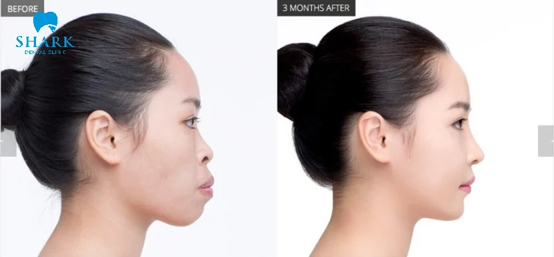 Phẫu thuật hàm để làm đều răng không cần niềng