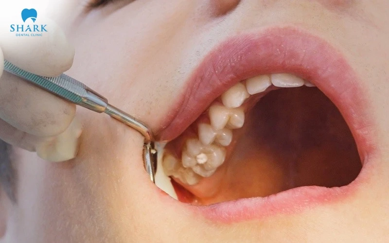 Điều trị nội nha kết hợp PRF