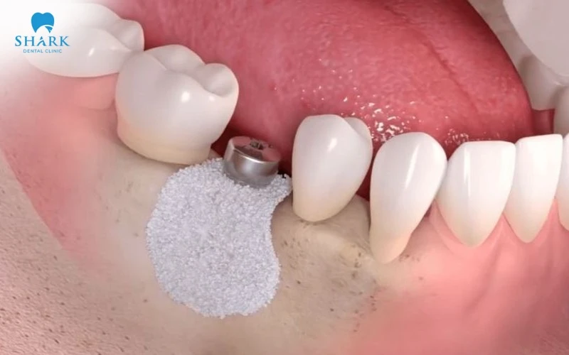 Cấy ghép Implant cùng PRF sẽ giúp quá trình lành thương diễn ra nhanh hơn