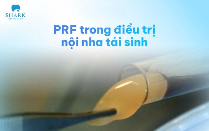 PRF được ứng dụng nhiều trong điều trị nội nha vì công dụng phục hồi nhanh chóng