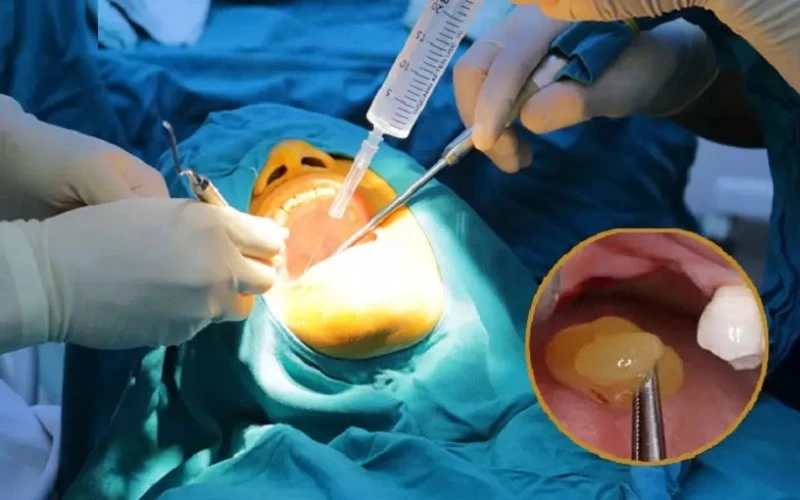 PRF cần được thực hiện trong môi trường vô trùng