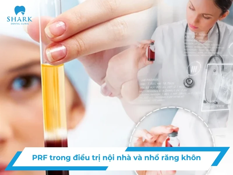 PRF là gì? Công nghệ giúp lành thương khi nhổ răng và nội nha 7 PRF là gì
