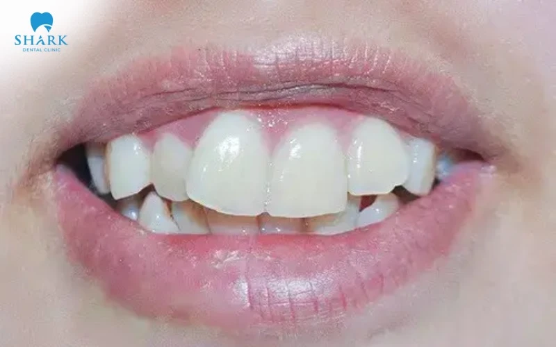 Răng lệch nhân trung