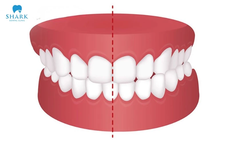 Răng lệch nhân trung do yếu tố bẩm sinh