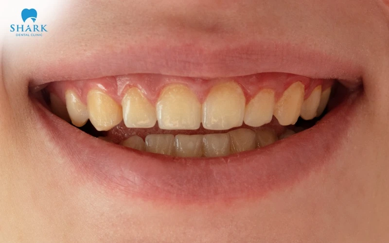 Răng bị lệch khỏi đường nhân trung khiến nụ cười kém thẩm mỹ