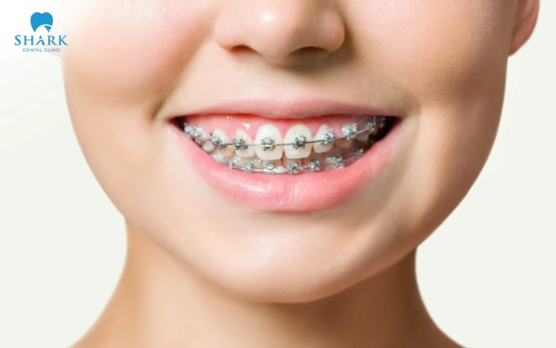 Chỉnh nha là giải pháp hiệu quả nhất đối với tình trạng răng lệch lạc