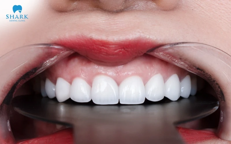 Răng sứ Multilayer Everest Speed là gì? Giá bao nhiêu tiền? 7 Răng sứ Multilayer Everest Speed có tính tương thích sinh học cao