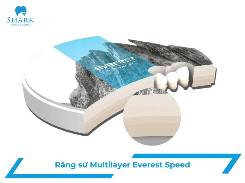 Răng sứ Multilayer Everest Speed
