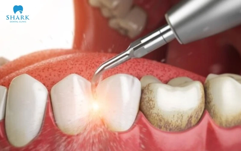 Thổi cát răng là dịch vụ hiện đại trong nha khoa ngày nay