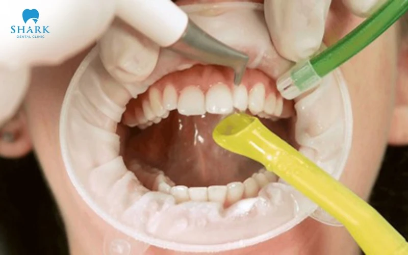 Lấy vôi răng bằng công nghệ thổi cát