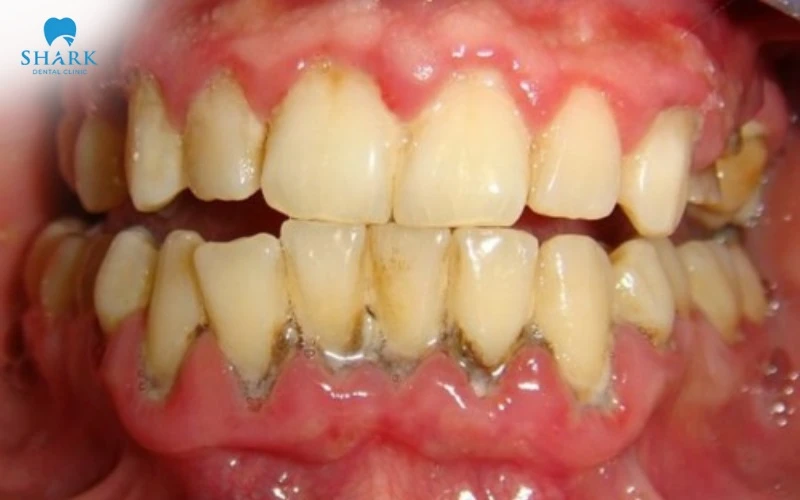 Loại bỏ mảng báo hiệu quả với công nghệ thổi cát răng